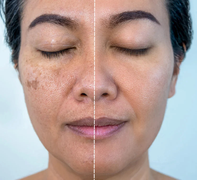 Korean Glutathione Dark Spot Erasing